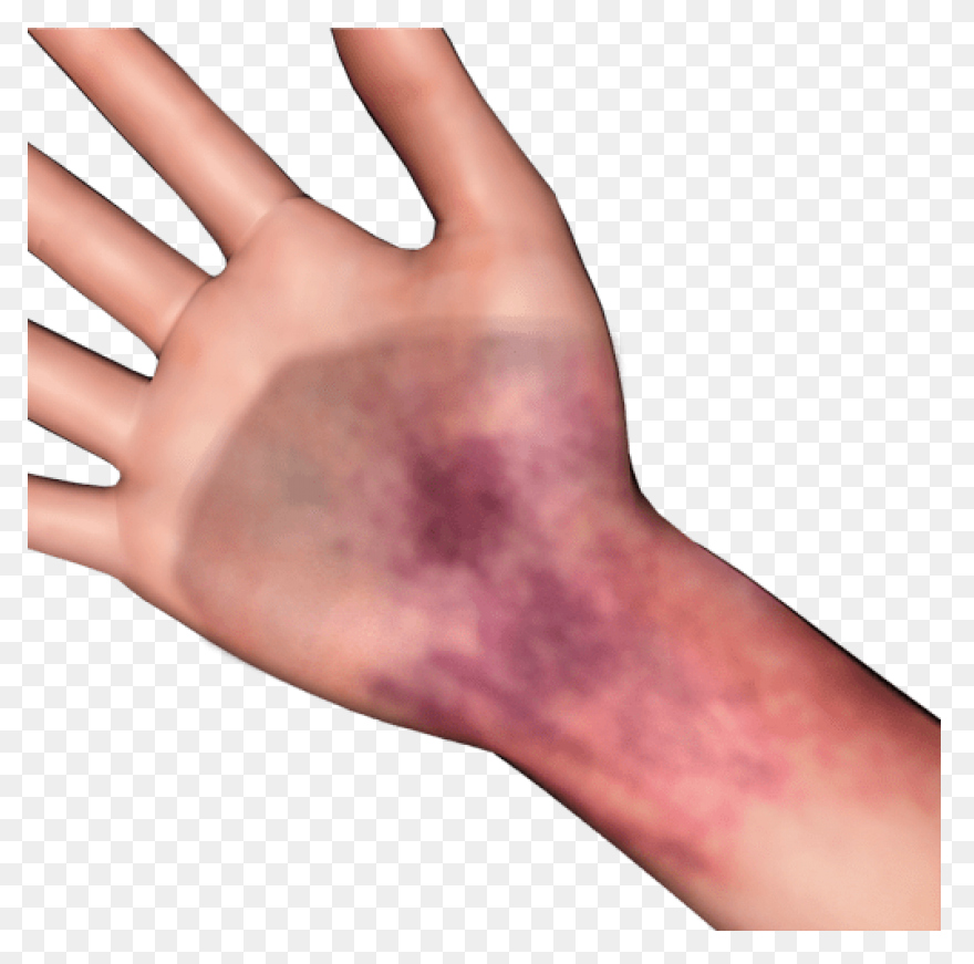 Bruise Blue Snelm - Wiki Clipart - 