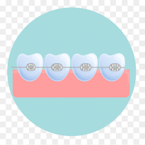 How Do Braces Work? - Peterson Fami