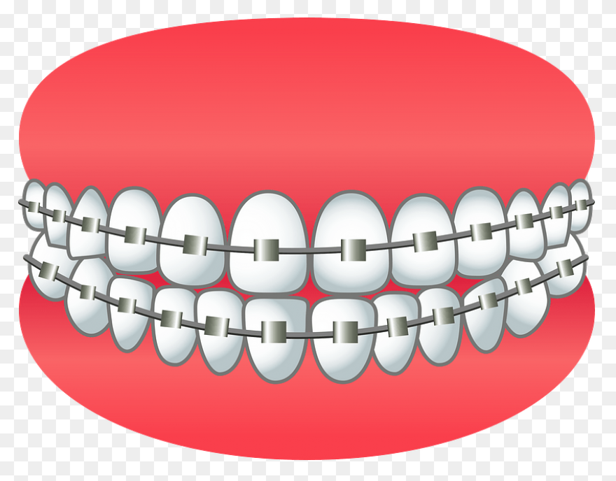 How Do Braces Work? - Peterson Fami