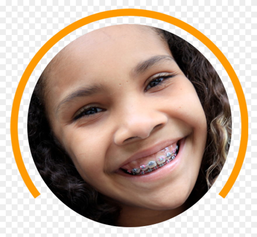 How Do Braces Work? - Peterson Fami