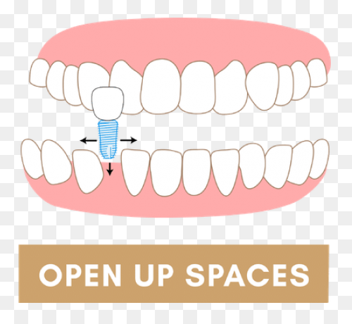 How Do Braces Work? - Peterson Fami
