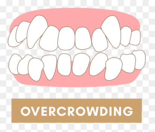 How Do Braces Work? - Peterson Fami