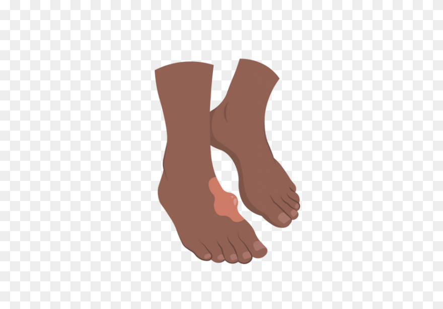 Hard Lump On Foot Causes - Foot