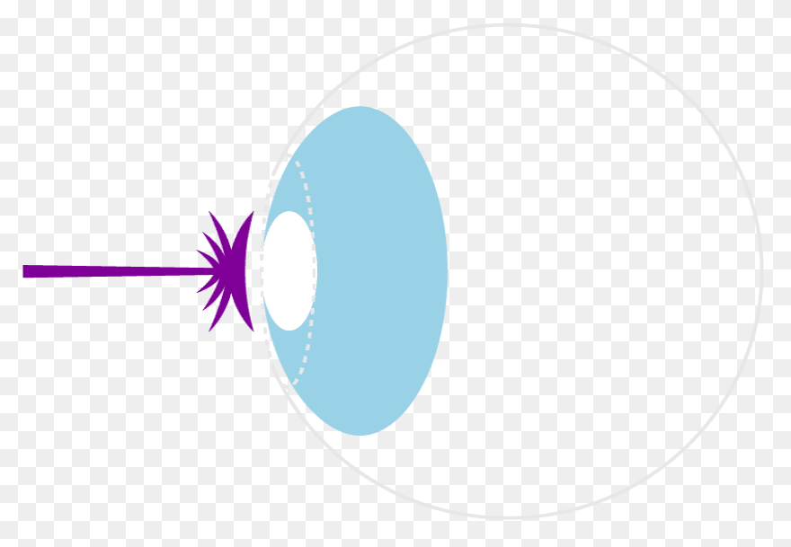 Photo Refractive Keratectomy (Prk) 