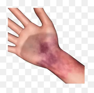 Need Some Face And Body Bruise Overlays! - Art Resources - Episode ClipartFlare.com 