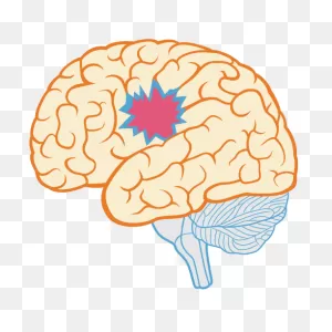 Brain Myth: Brain Damage Is Always Permanent - ClipartFlare From Posit ClipartFlare.com 