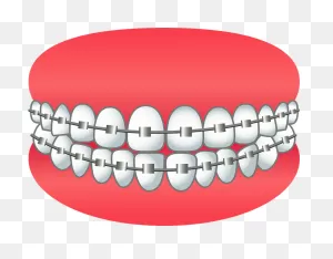 Dental Braces Clipart - Dental Braces - Png Download - Full Size ClipartFlare.com 