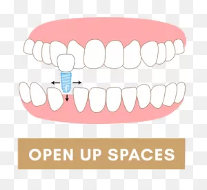 How To Determine If You Need Braces For Teeth Straightening | The ClipartFlare.com 