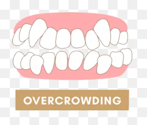 How To Determine If You Need Braces For Teeth Straightening | The ClipartFlare.com 