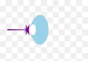Lasik Eye Surgery And Treatment In London | Focus Clinics