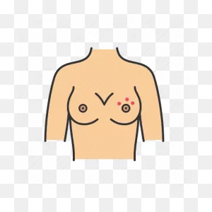Breast Rash, Dermatitis, Dimpling, Irritation, Itchy, Nipple, Skin ClipartFlare.com 