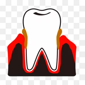 Dental Plaque Calculus Periodontal Hospital View All Clipart ClipartFlare.com 