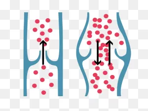 Varicose Veins - Vein Clinic Dublin Drogheda Cavan